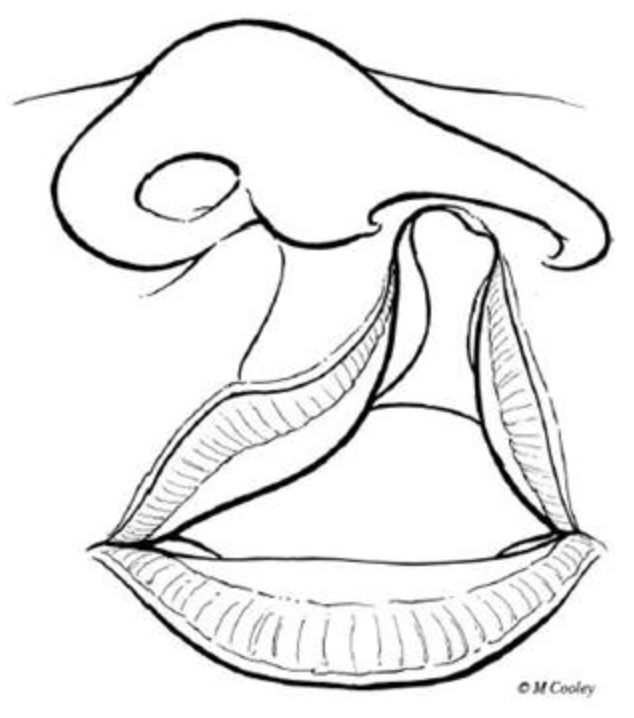 Cleft Lip and Palate